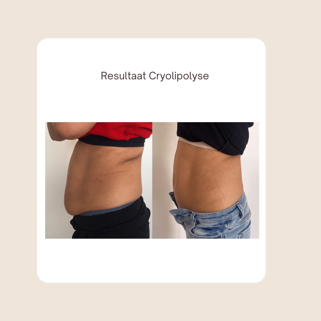 Voor- en na-resultaat van een cryolipolyse-behandeling
